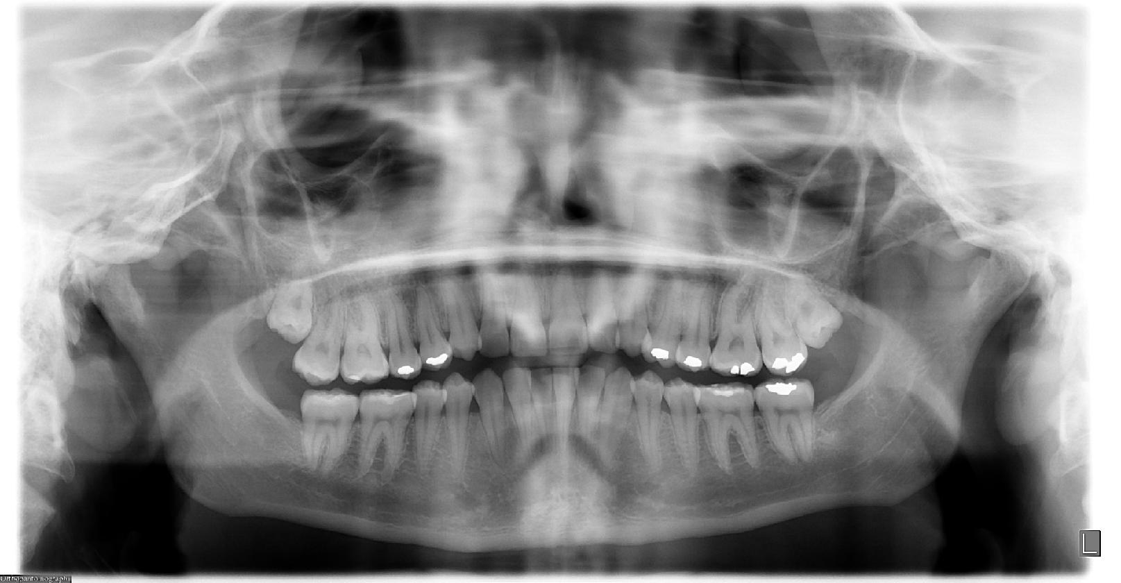 Panoramic Dental X-ray